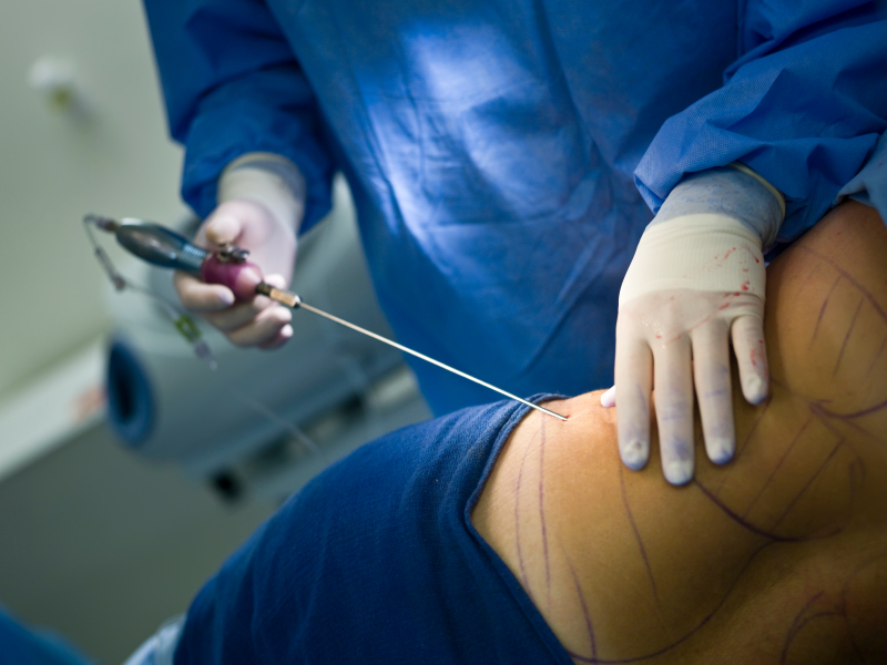 Liposuccion