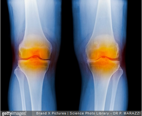 arthrose-facteurs