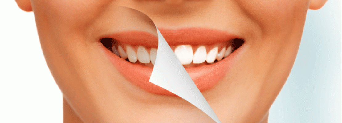 blanchiment-des-dents