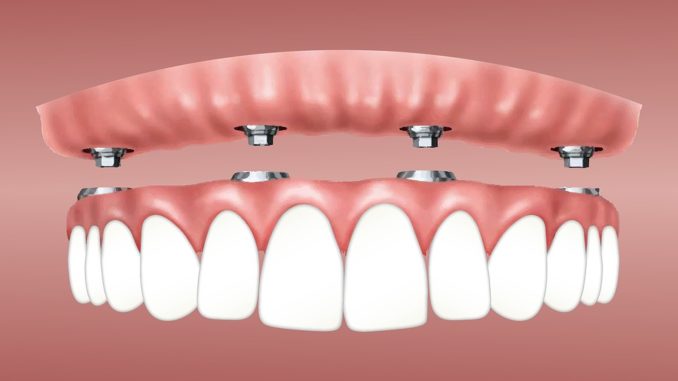 overdenture-3597628_960_720