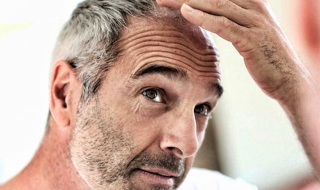 La greffe capillaire, un résultat efficace et définitif