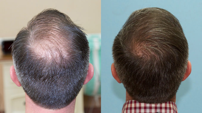 implants capillaires