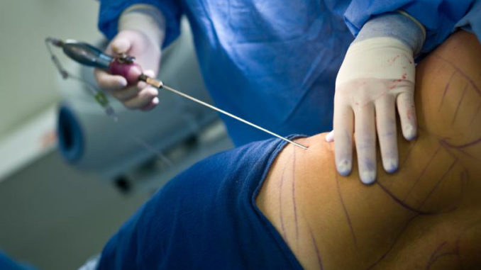 operation-de-liposuccion