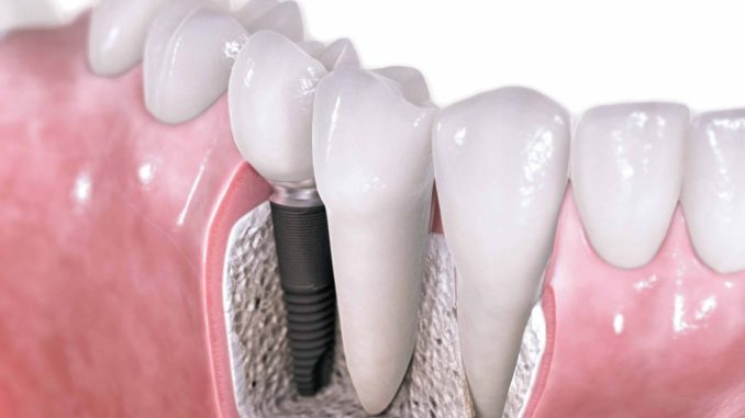 Comment trouver des implants dentaires à bas prix Comment trouver des implants dentaires à bas prix