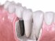 Comment trouver des implants dentaires à bas prix