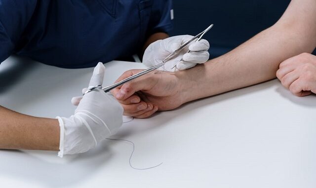 sutures et ligature sutures et ligature