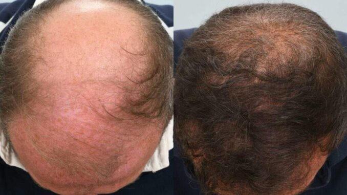 alopécie androgénétique