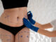 Liposuccion