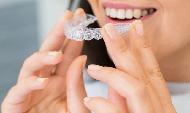 alignement des dents